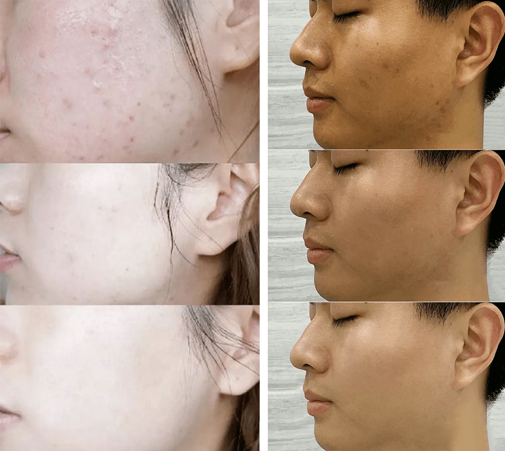 痘痘|夏天变黑长痘不可怕，赶紧用它，让你的皮肤恢复婴儿的光滑，痘痘，黑头，螨虫全都消失了