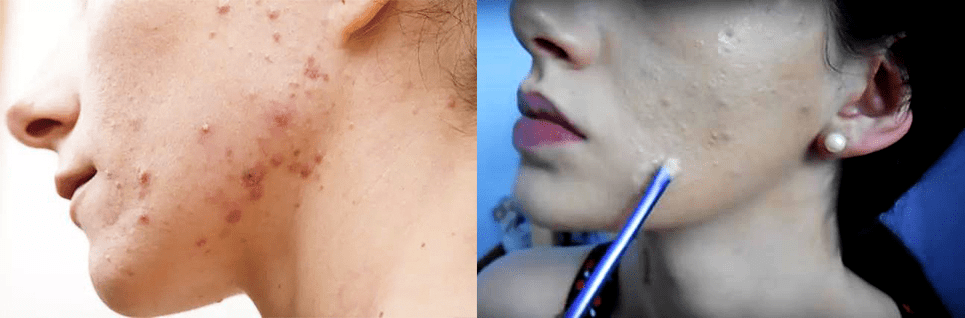 痘痘|夏天变黑长痘不可怕，赶紧用它，让你的皮肤恢复婴儿的光滑，痘痘，黑头，螨虫全都消失了