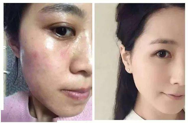 痘痘|夏天变黑长痘不可怕，赶紧用它，让你的皮肤恢复婴儿的光滑，痘痘，黑头，螨虫全都消失了