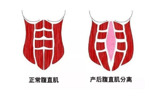 尤其是到了妊娠晚期,两侧的腹直肌会从腹中线——也就是腹白线的位置