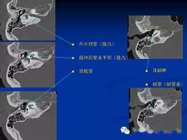 耳部ct及mri解剖