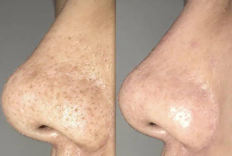 鼻子|米粒大的黑头，瞬间吸出，整个鼻子新生了！