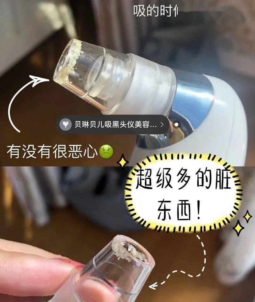 鼻子|米粒大的黑头，瞬间吸出，整个鼻子新生了！