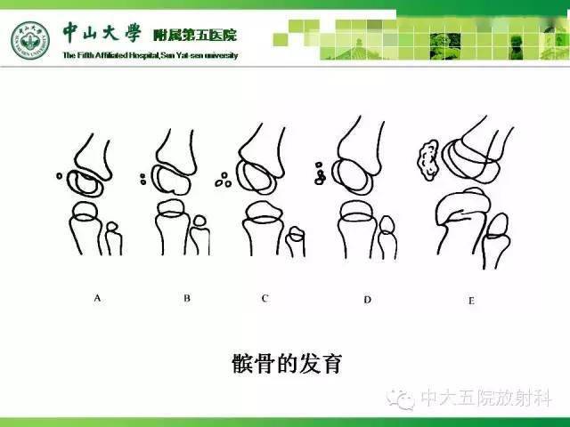 骨关节影像常见解剖变异