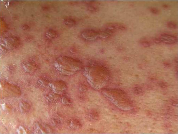 抗结核|抗结核药物的皮肤不良反应