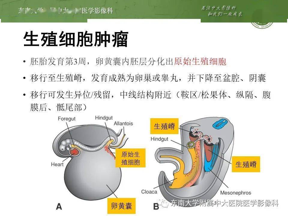 【晨读结果公布】2020.09.21 神经系统疾病——生殖细胞肿瘤