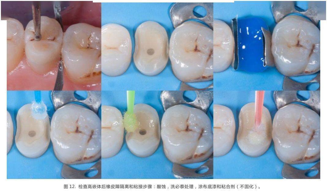 病例分享前磨牙根管治疗后的高嵌体修复