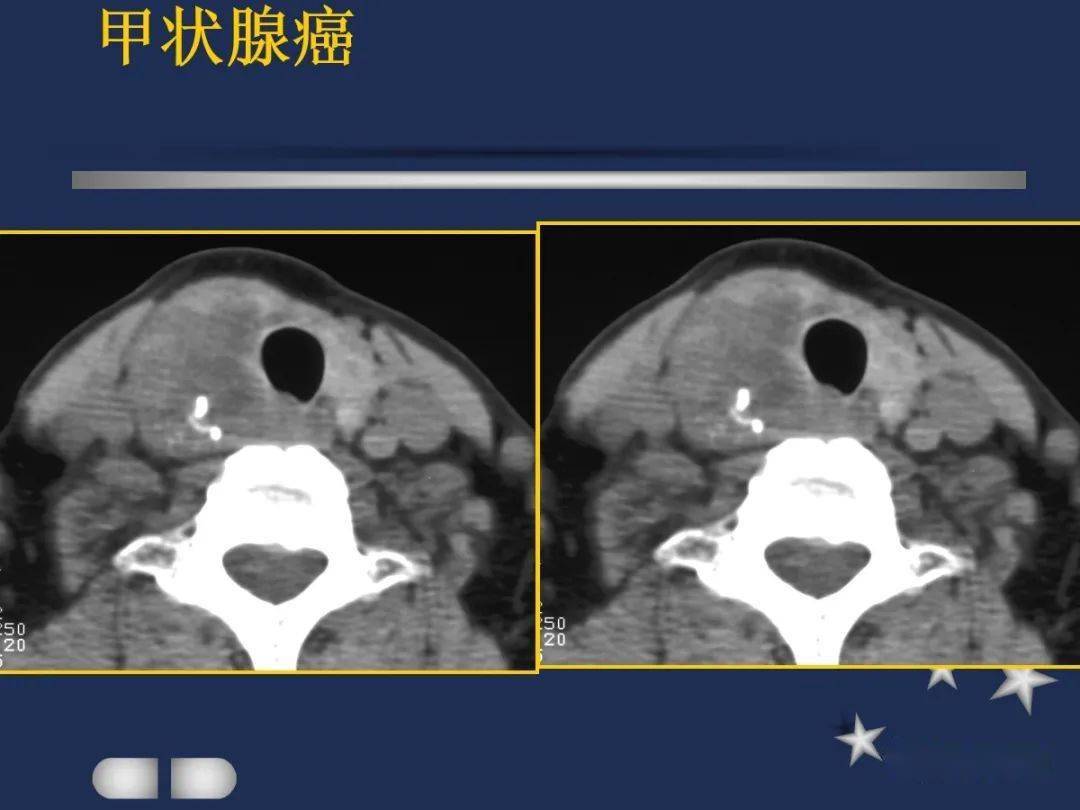 常突破甲状腺被膜向周围侵润;在增扫时可见环状强化;由于ct和mri能增