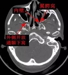 一文搞定:翼腭窝的ct影像解剖 值得收藏