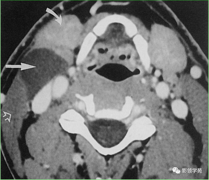 右侧第二鳃裂囊肿:囊肿位于颈内动,静脉的外侧,颌下腺后方,胸锁乳突肌