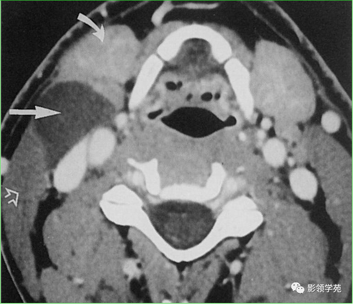 7种常见颈部囊性占位病变的ct表现