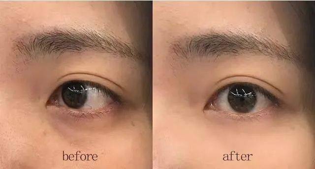 黑眼圈|马应龙新款眼霜买1送5，拼网速抢购中！早晚用一次，轻松缓解黑眼圈、浮肿眼袋、细纹皱纹，40岁阿姨也能抹出少女眼！