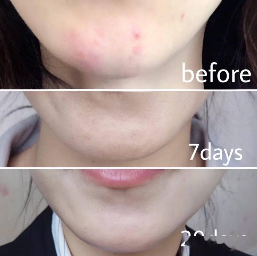 皮肤|刷酸=换脸？这个明星们超爱的百元刷酸好物搞定你的痘痘、闭口、黑头毛孔粗大还不怕烂脸！