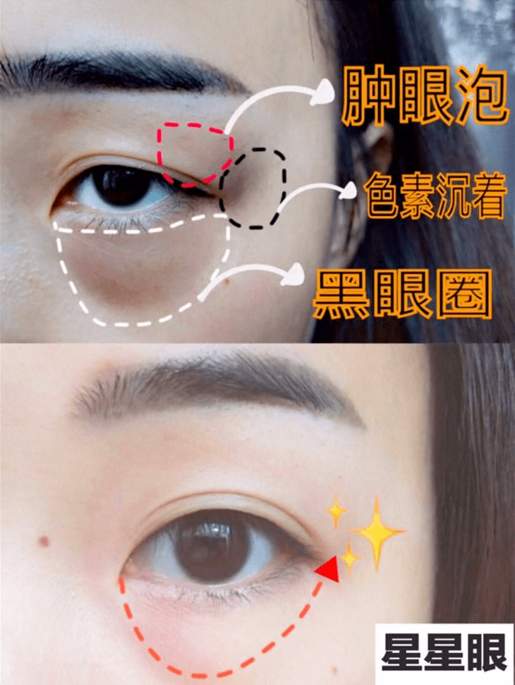 黑眼圈|马应龙新款眼霜买1送5，拼网速抢购中！早晚用一次，轻松缓解黑眼圈、浮肿眼袋、细纹皱纹，40岁阿姨也能抹出少女眼！