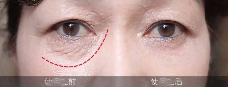 黑眼圈|马应龙新款眼霜买1送5，拼网速抢购中！早晚用一次，轻松缓解黑眼圈、浮肿眼袋、细纹皱纹，40岁阿姨也能抹出少女眼！