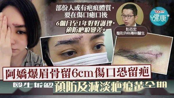 减淡疤痕阿娇爆眉骨留6cm伤口恐留疤整形外科专科医生拆解预防及减淡