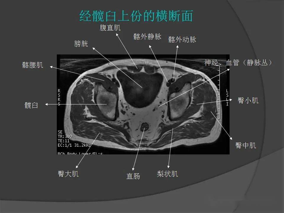 骨盆肌肉mri断层解剖