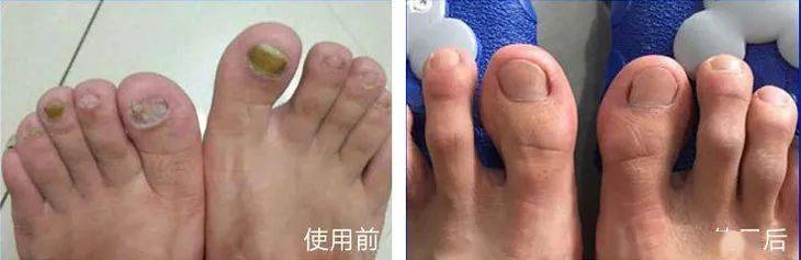 真菌|用“笔”刷一刷，灰指甲竟慢慢变光亮了