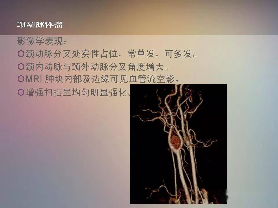 颈动脉分叉处实性占位的影像诊断