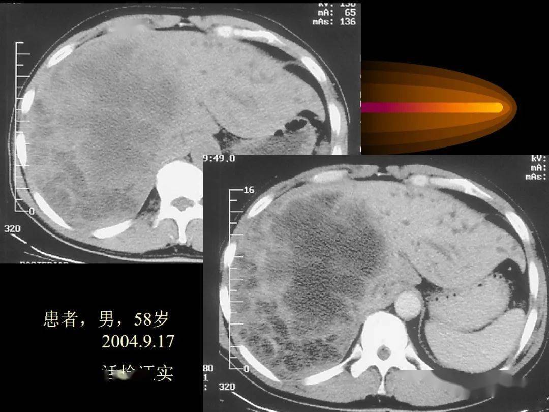 肝内周围型胆管细胞癌的影像特征