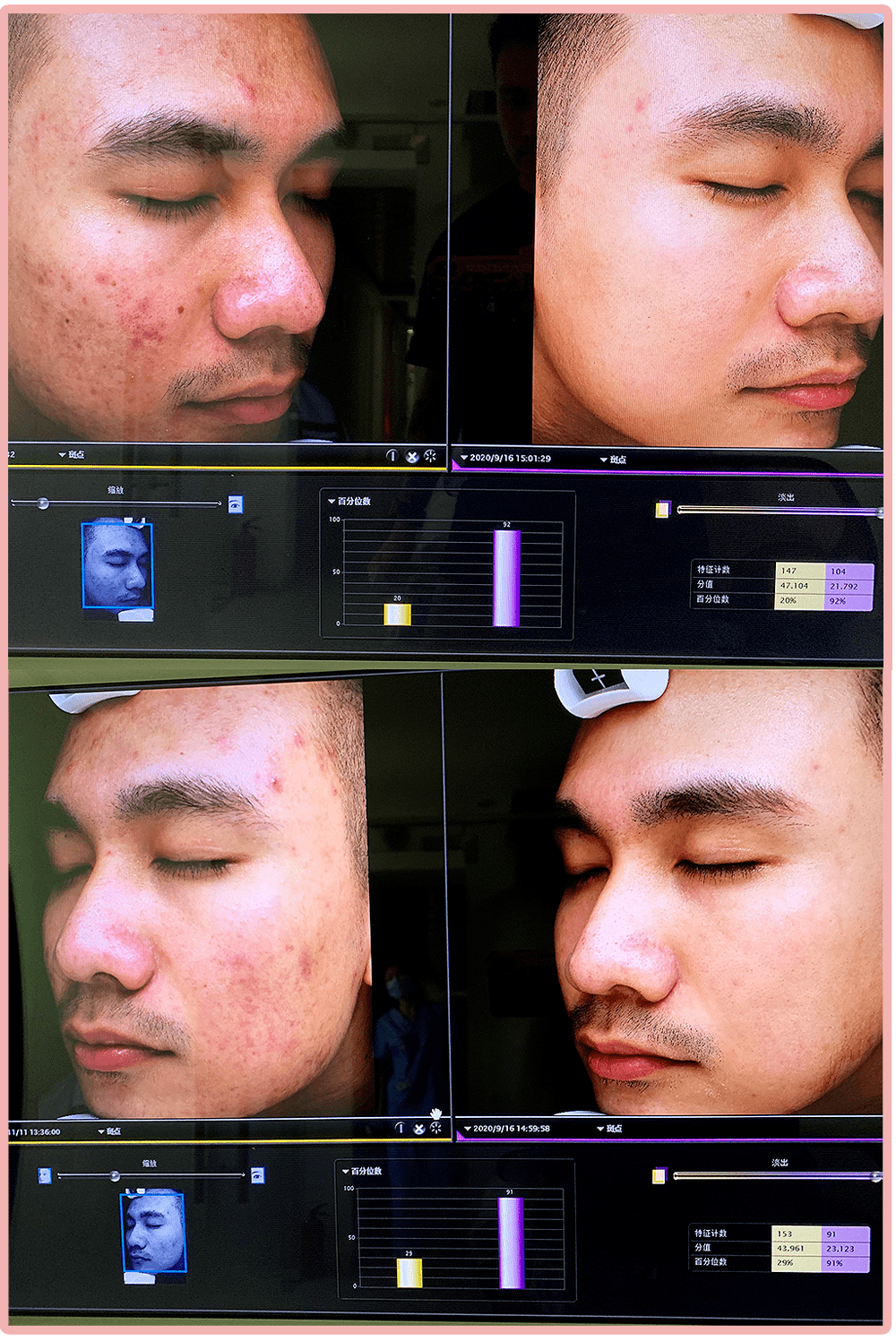 时间|我花3年时间才治好脸，还曾被美容院骗了上万元…