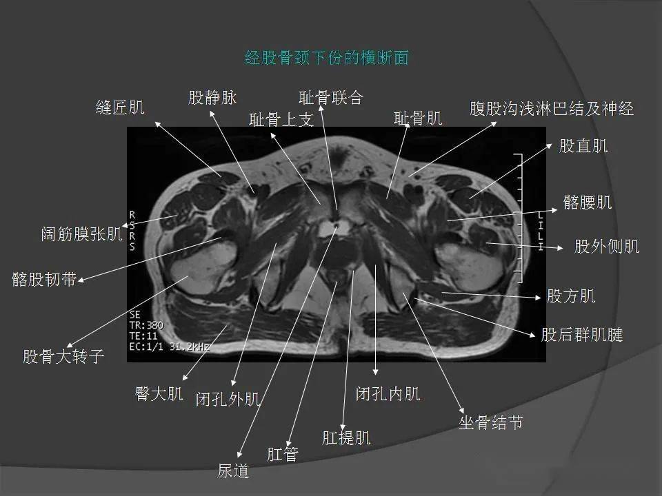 骨盆肌肉mri断层解剖