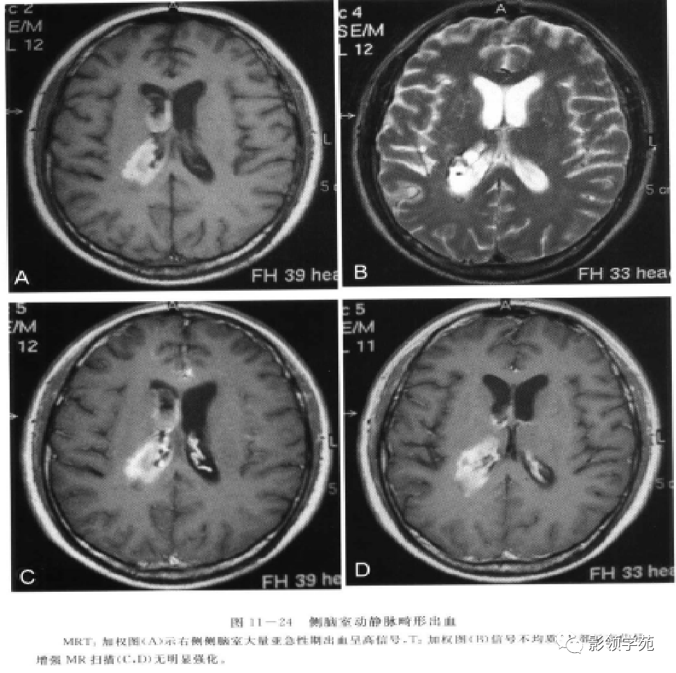 神经上皮囊肿可以位于脉络膜丛和脑室,偶尔也可以位于脑实质内.