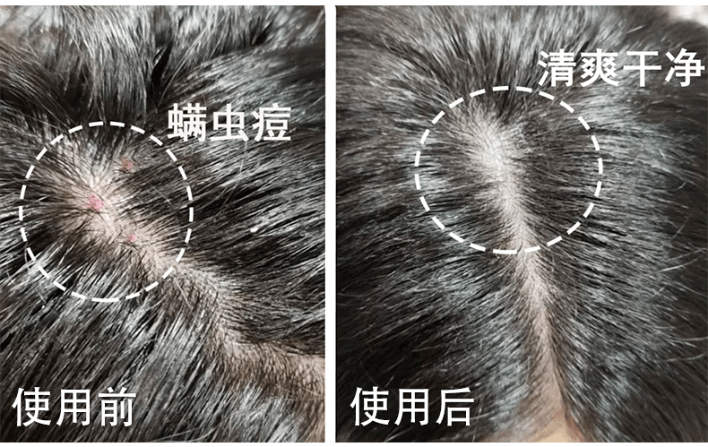 头发|头皮发痒，出油，还掉发？原来是你的洗发水没选好...