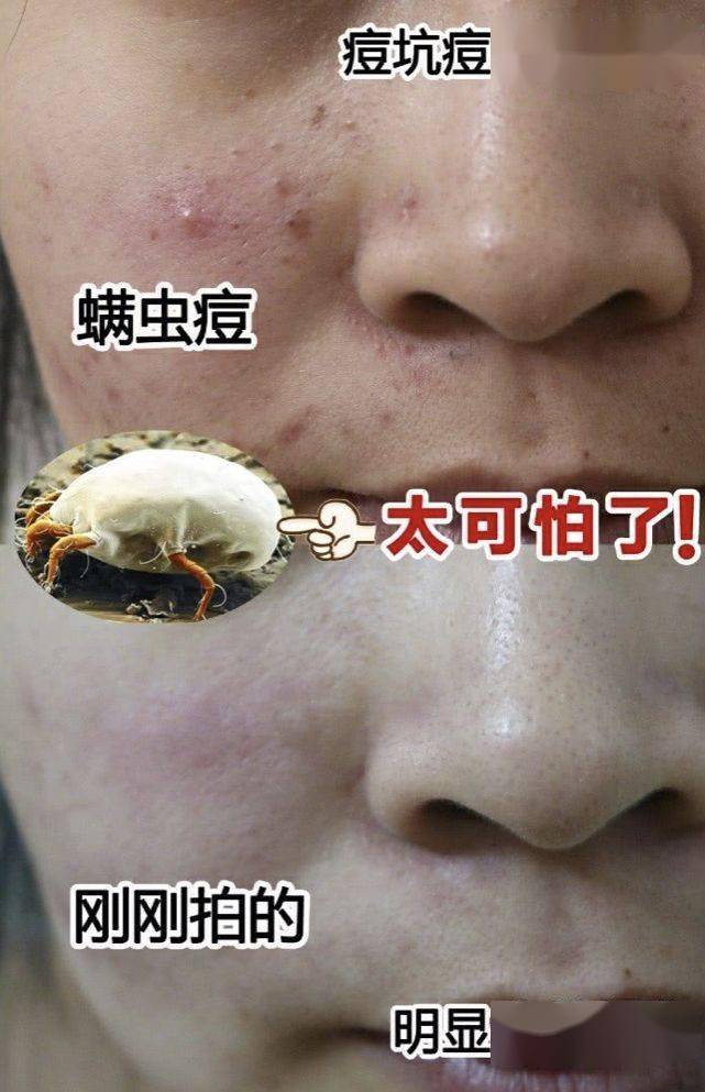 氨基酸|拒绝“螨虫脸”，5秒揉一揉，螨虫全出来了，痘痘黑头全没了！