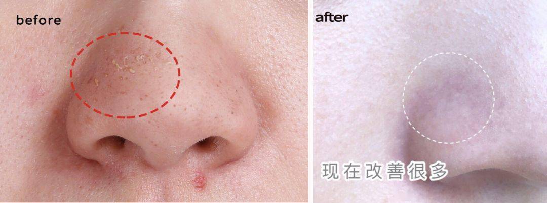 氨基酸|拒绝“螨虫脸”，5秒揉一揉，螨虫全出来了，痘痘黑头全没了！