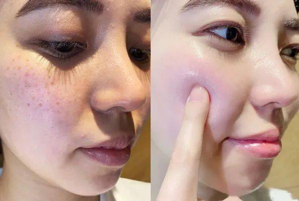 女人|如果你正长“色斑”,试试这个新方法,惊喜到让你尖叫!