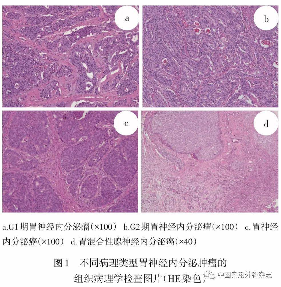 论著胃神经内分泌肿瘤96例临床病理特征及预后分析