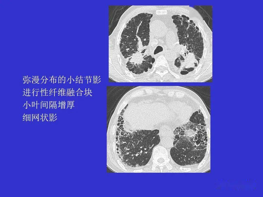 肺部间质性病变的ct诊断