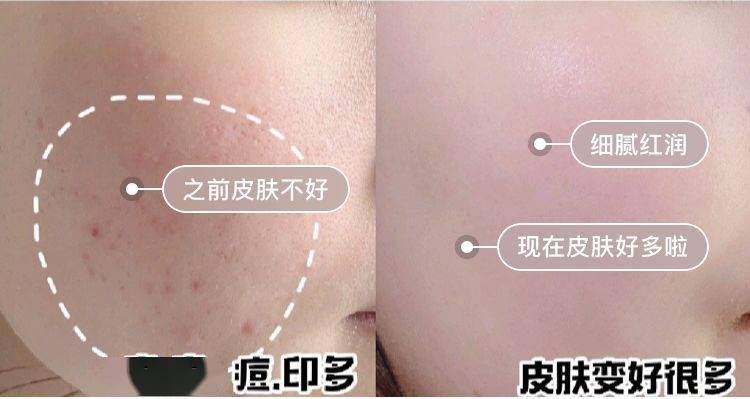 氨基酸|拒绝“螨虫脸”，5秒揉一揉，螨虫全出来了，痘痘黑头全没了！