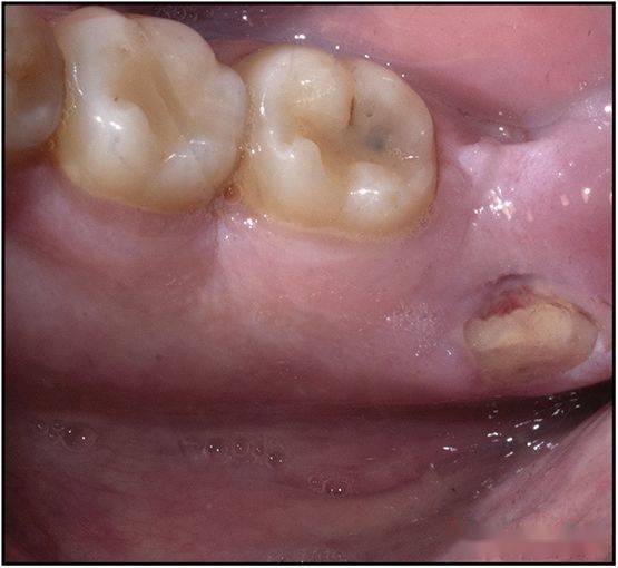 手术2周后病损部位愈合讨论在牙齿印模之后,死骨的暴露是一种罕见的