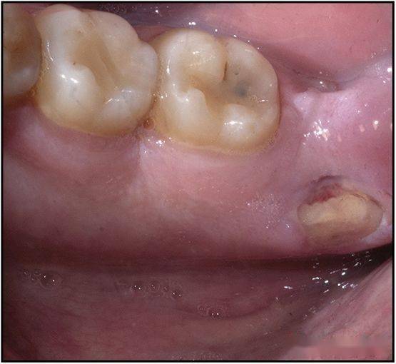 【病例分享】牙列取模后下颌骨舌侧坏死