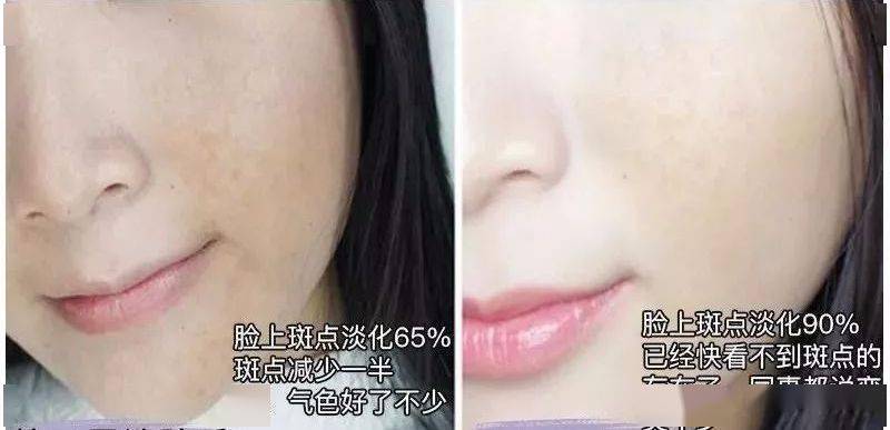 色斑|连抹7天,斑没了,皮肤真的白一度!