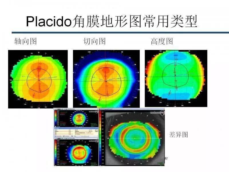 眼视光角膜地形图阅读及基本使用