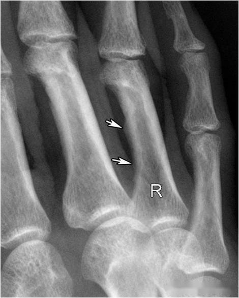 一文掌握手部7个正常x线征象_指骨