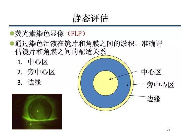 荧光有助于评价镜片和角膜之间的泪液情况,以了解镜片后表面和角膜前