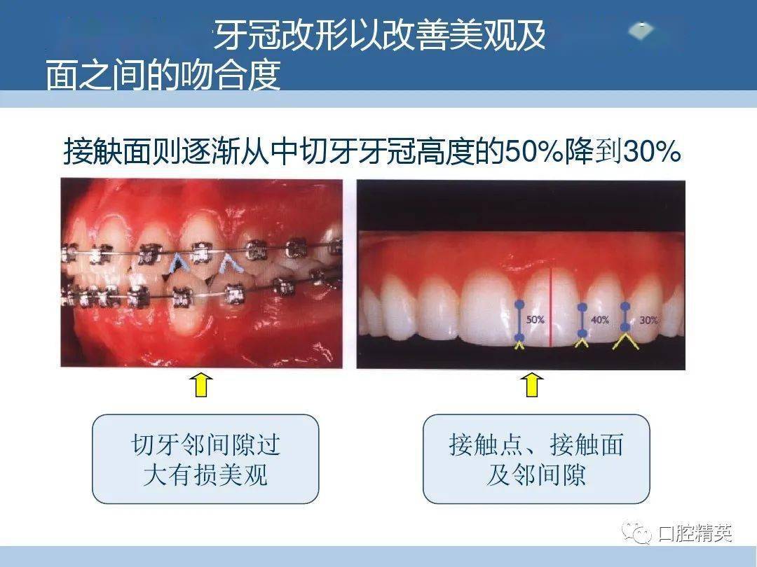 托槽粘结