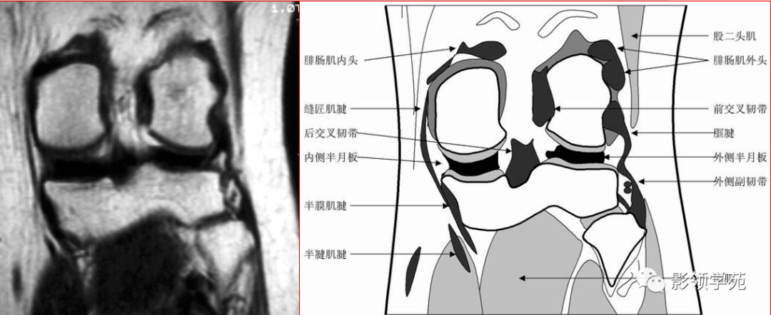 交叉韧带解剖及损伤的mri诊断_膝关节