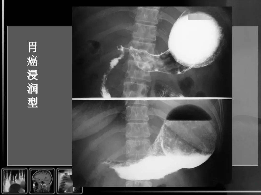 【汇总】消化道疾病影像诊断与鉴别_造影