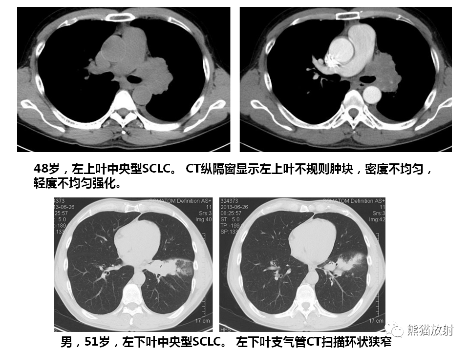 纵隔 小细胞癌你想到了吗?有收获吗?