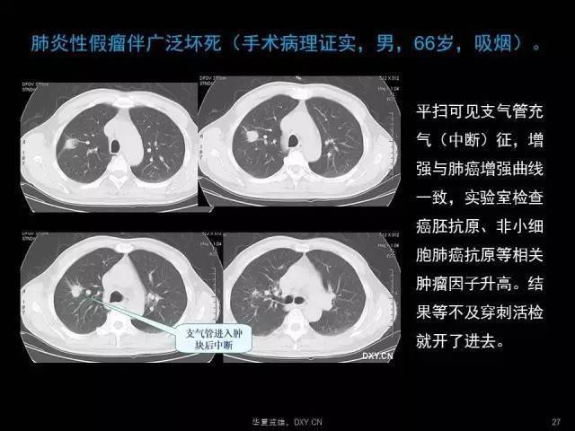 影像诊断鉴别:肺癌,肺炎,肺结核