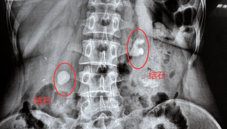 有这种疾病的人,得肾结石的几率高出常人200倍,医生也
