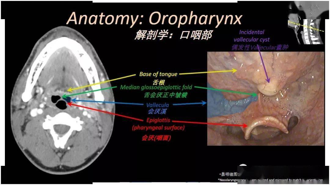 精彩推荐丨内窥镜对照的咽喉部ct解剖