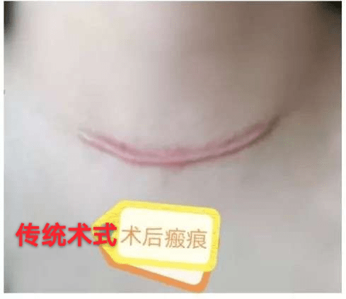 "刀过无痕"哈医大二院开展经口甲状腺癌切除术_手术