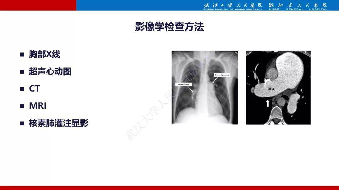 肺动脉高压临床分类及ct表现