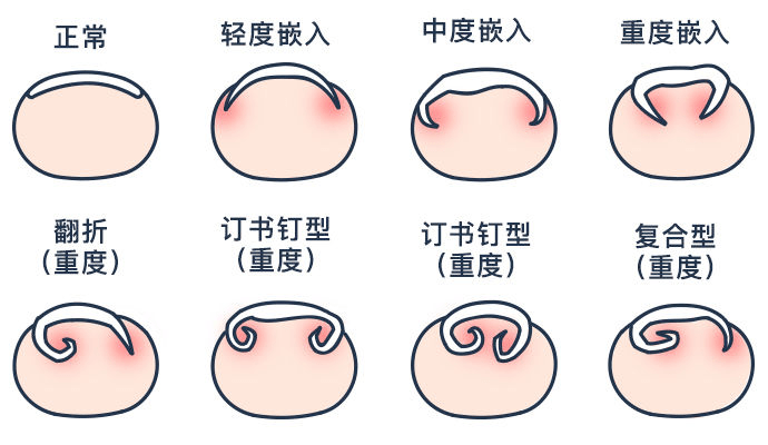 为什么脚容易得甲沟炎 aed5400d8ec8483fb83c666341655b46.png